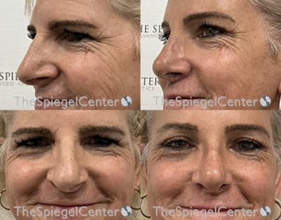 Rhinoplasty Before & After Gallery - Patient 115796 - Image 1
