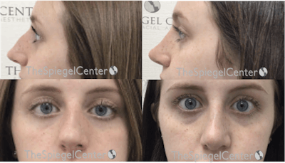 Rhinoplasty Before & After Gallery - Patient 367144 - Image 1