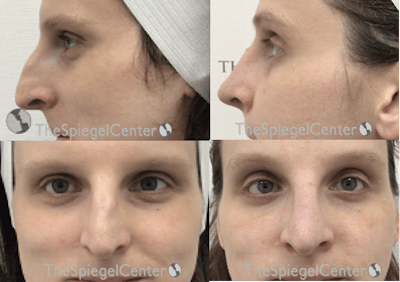 Rhinoplasty Before & After Gallery - Patient 190896 - Image 1