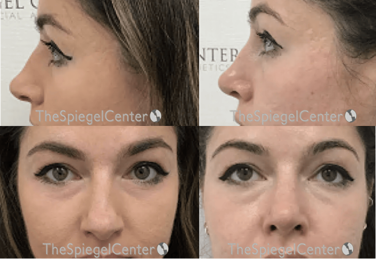 Rhinoplasty Before & After Gallery - Patient 191120 - Image 1