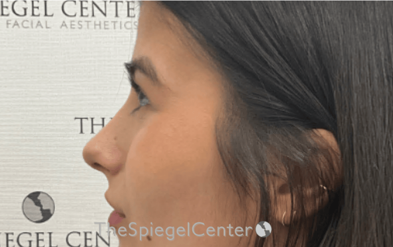 Rhinoplasty Before & After Gallery - Patient 261878 - Image 2