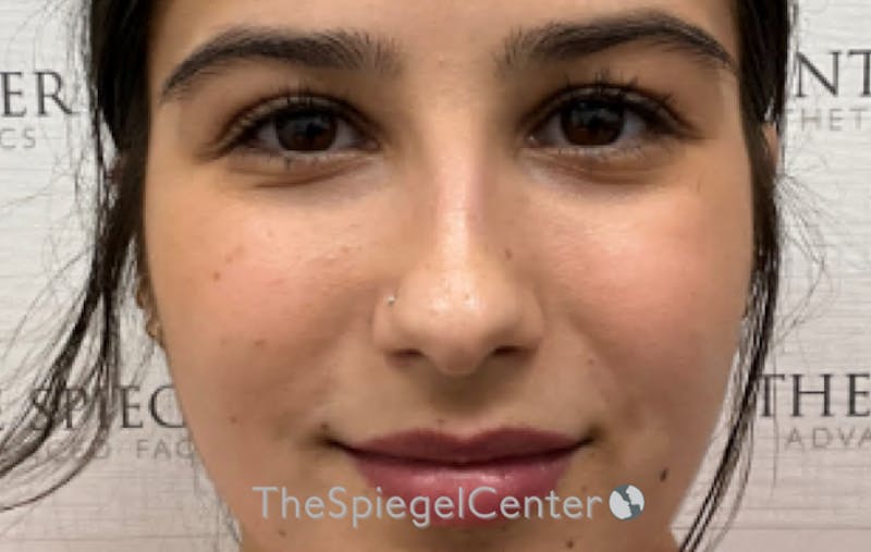 Rhinoplasty Before & After Gallery - Patient 261878 - Image 3