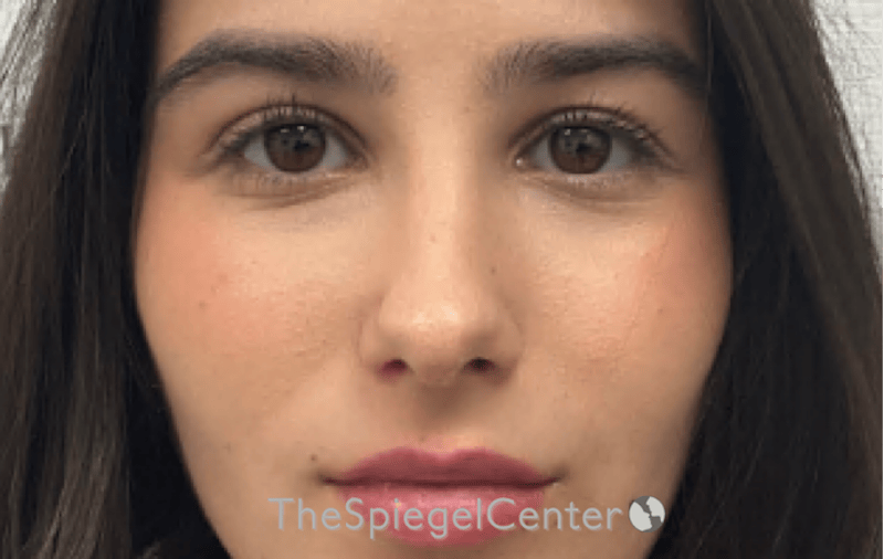 Rhinoplasty Before & After Gallery - Patient 261878 - Image 4