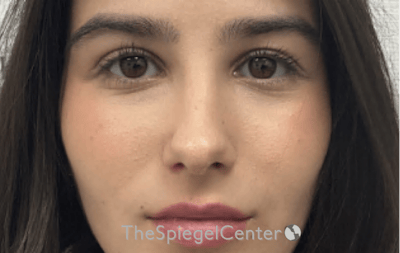 Rhinoplasty Before & After Gallery - Patient 261878 - Image 4