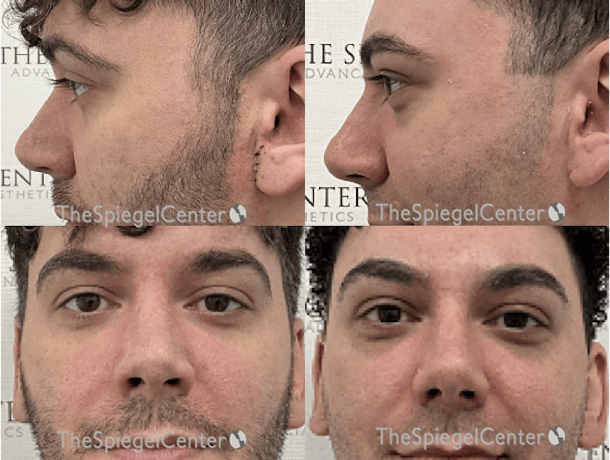 Rhinoplasty Before & After Gallery - Patient 298415 - Image 1