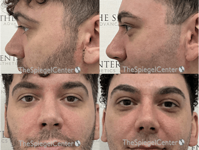Rhinoplasty Before & After Gallery - Patient 298415 - Image 1