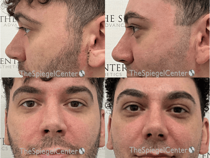 Rhinoplasty Before & After Gallery - Patient 298415 - Image 1