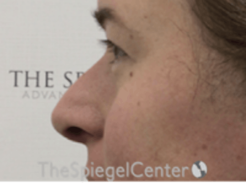 Rhinoplasty Before & After Gallery - Patient 125798 - Image 1