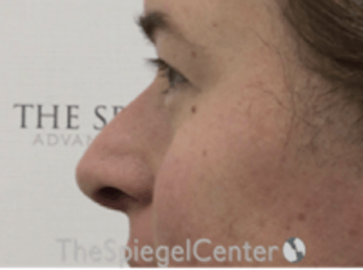 Rhinoplasty Before & After Gallery - Patient 125798 - Image 1