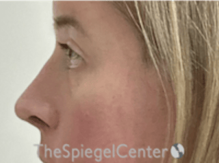 Rhinoplasty Before & After Gallery - Patient 125798 - Image 2