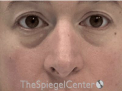 Rhinoplasty Before & After Gallery - Patient 125798 - Image 3