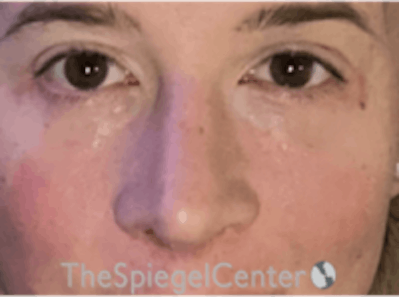 Rhinoplasty Before & After Gallery - Patient 125798 - Image 4