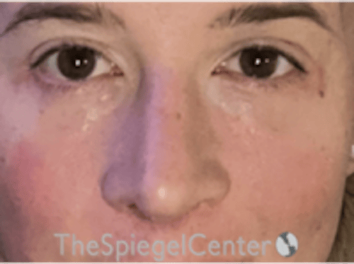 Rhinoplasty Before & After Gallery - Patient 125798 - Image 4
