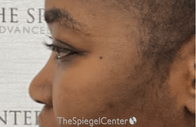 Rhinoplasty Before & After Gallery - Patient 402916 - Image 1