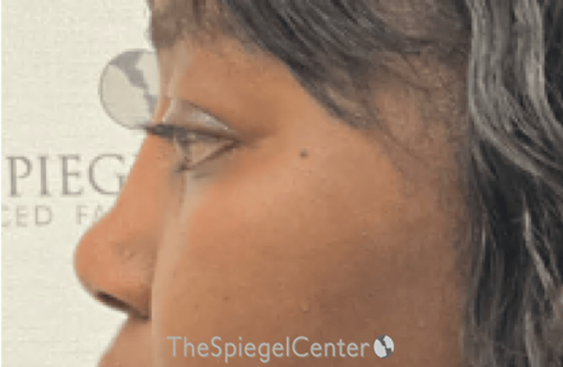 Rhinoplasty Before & After Gallery - Patient 402916 - Image 2