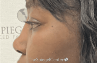Rhinoplasty Before & After Gallery - Patient 402916 - Image 2