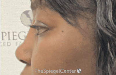 Rhinoplasty Before & After Gallery - Patient 402916 - Image 2
