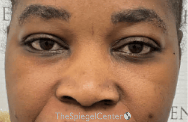 Rhinoplasty Before & After Gallery - Patient 402916 - Image 3