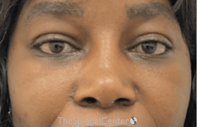 Rhinoplasty Before & After Gallery - Patient 402916 - Image 4