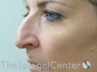Rhinoplasty Before & After Gallery - Patient 315874 - Image 1