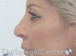 Rhinoplasty Before & After Gallery - Patient 315874 - Image 2