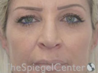 Rhinoplasty Before & After Gallery - Patient 315874 - Image 4