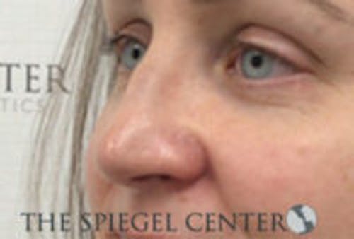 Rhinoplasty Before & After Gallery - Patient 283347 - Image 1