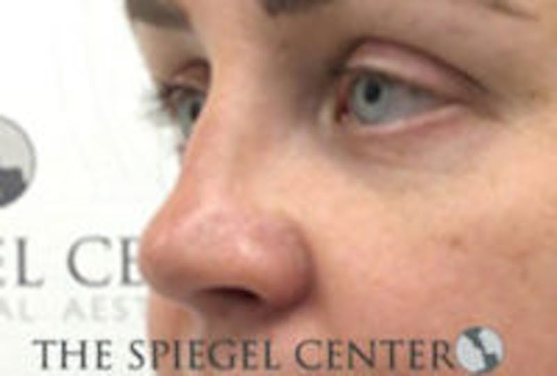 Rhinoplasty Before & After Gallery - Patient 283347 - Image 2