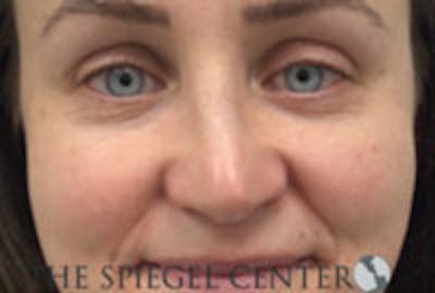 Rhinoplasty Before & After Gallery - Patient 283347 - Image 3