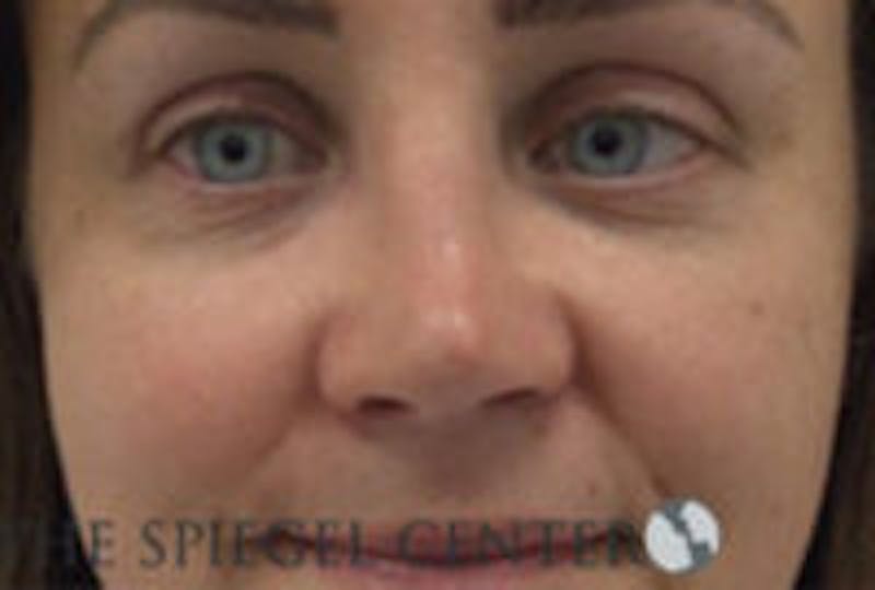 Rhinoplasty Before & After Gallery - Patient 283347 - Image 4