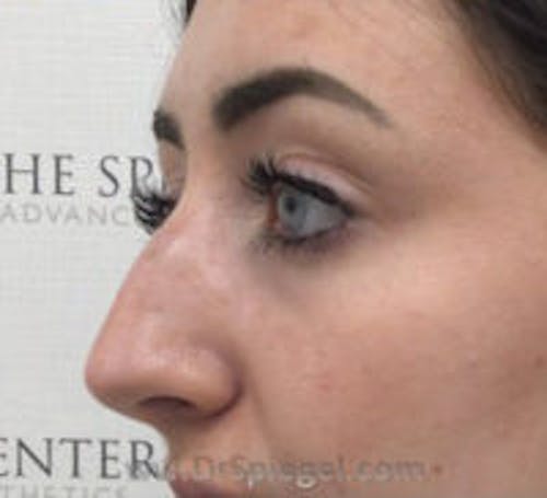 Rhinoplasty Before & After Gallery - Patient 617680 - Image 1