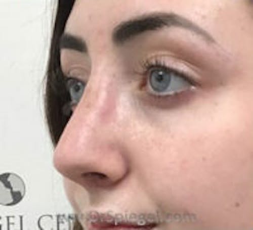 Rhinoplasty Before & After Gallery - Patient 617680 - Image 2