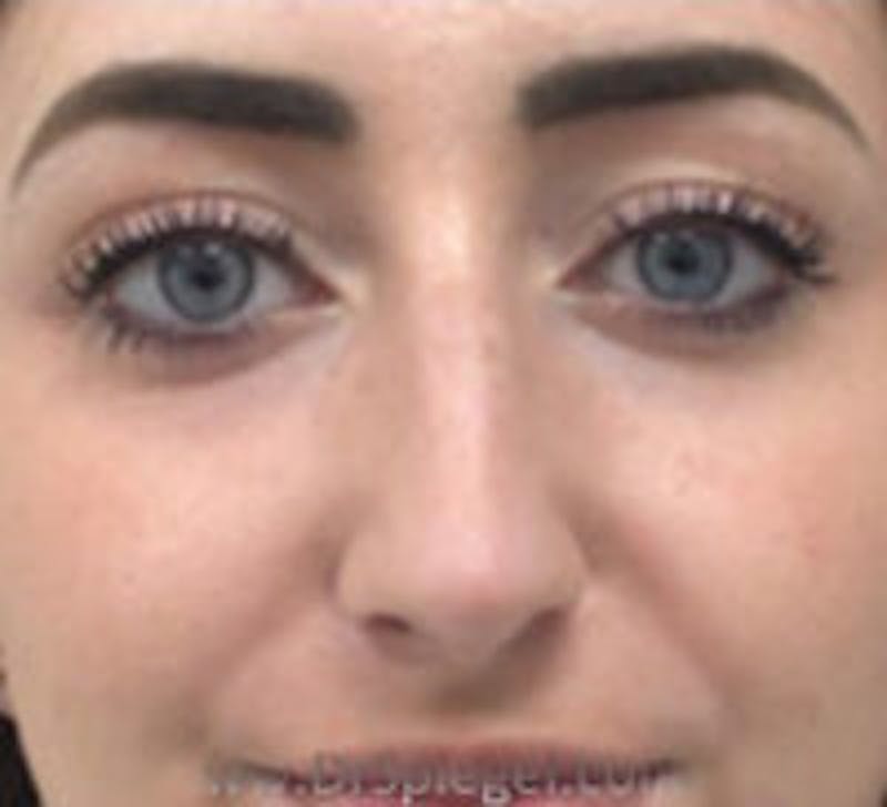 Rhinoplasty Before & After Gallery - Patient 617680 - Image 3