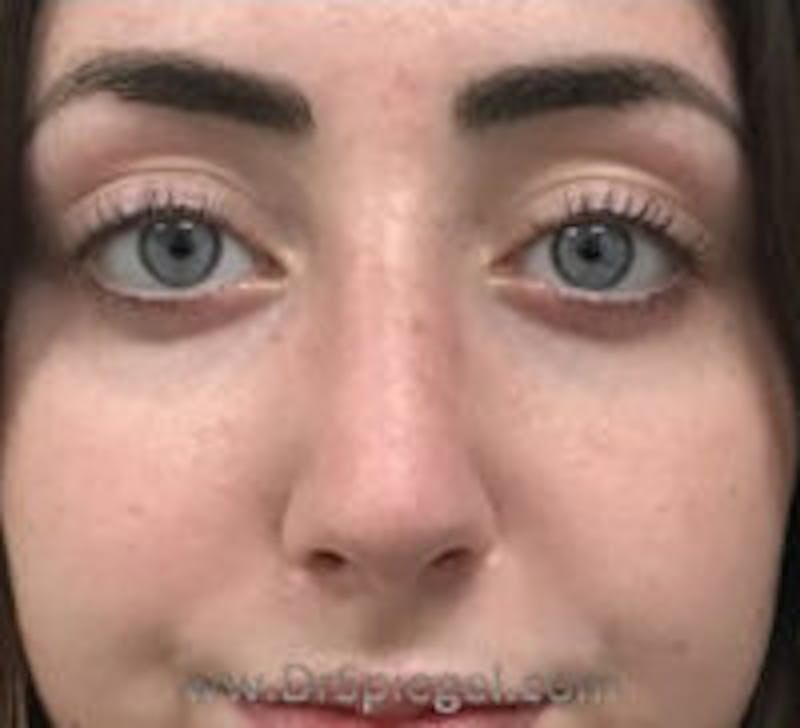 Rhinoplasty Before & After Gallery - Patient 617680 - Image 4