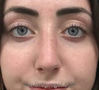 Rhinoplasty Before & After Gallery - Patient 617680 - Image 4