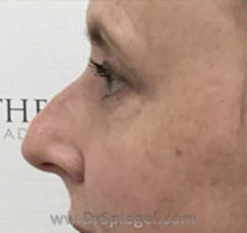 Rhinoplasty Before & After Gallery - Patient 102110 - Image 1