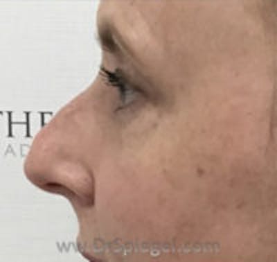 Rhinoplasty Before & After Gallery - Patient 102110 - Image 1