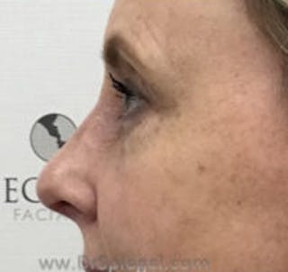 Rhinoplasty Before & After Gallery - Patient 102110 - Image 2