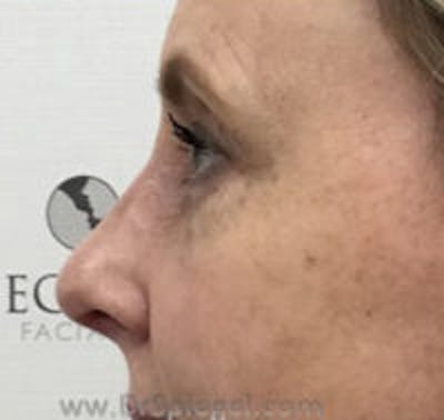 Rhinoplasty Before & After Gallery - Patient 102110 - Image 2