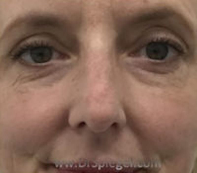 Rhinoplasty Before & After Gallery - Patient 102110 - Image 3