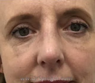 Rhinoplasty Before & After Gallery - Patient 102110 - Image 4