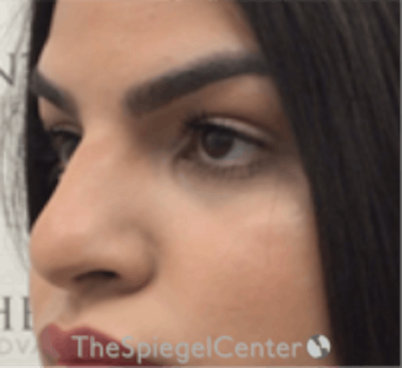 Rhinoplasty Before & After Gallery - Patient 260354 - Image 1