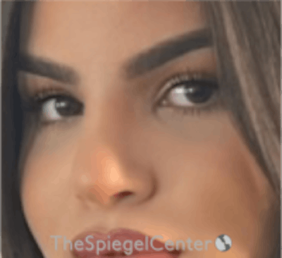 Rhinoplasty Before & After Gallery - Patient 260354 - Image 2