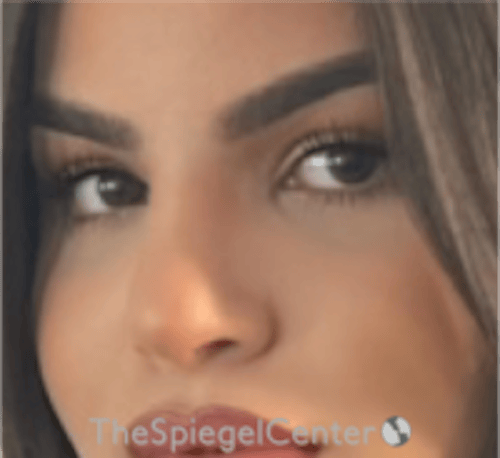Rhinoplasty Before & After Gallery - Patient 260354 - Image 2