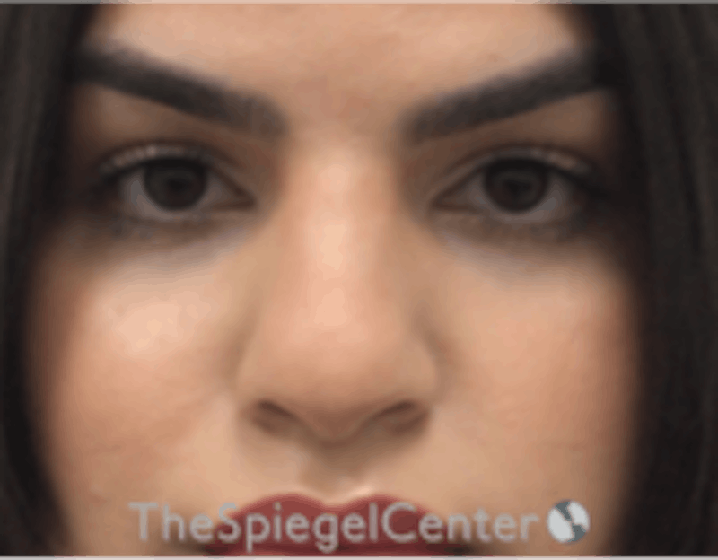 Rhinoplasty Before & After Gallery - Patient 260354 - Image 3
