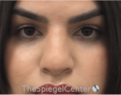 Rhinoplasty Before & After Gallery - Patient 260354 - Image 3