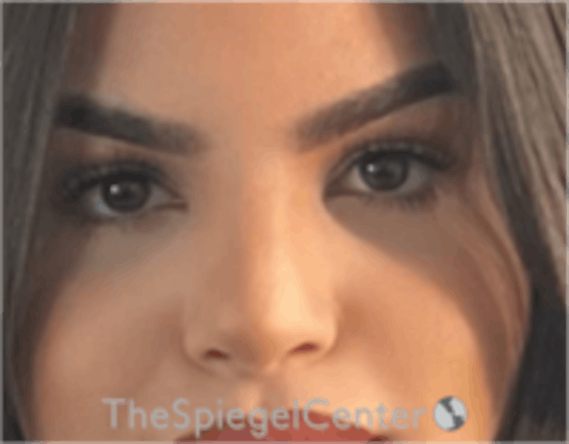 Rhinoplasty Before & After Gallery - Patient 260354 - Image 4