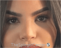 Rhinoplasty Before & After Gallery - Patient 260354 - Image 4