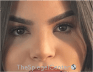 Rhinoplasty Before & After Gallery - Patient 260354 - Image 4