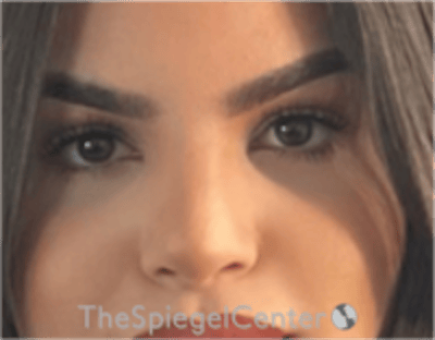 Rhinoplasty Before & After Gallery - Patient 260354 - Image 4